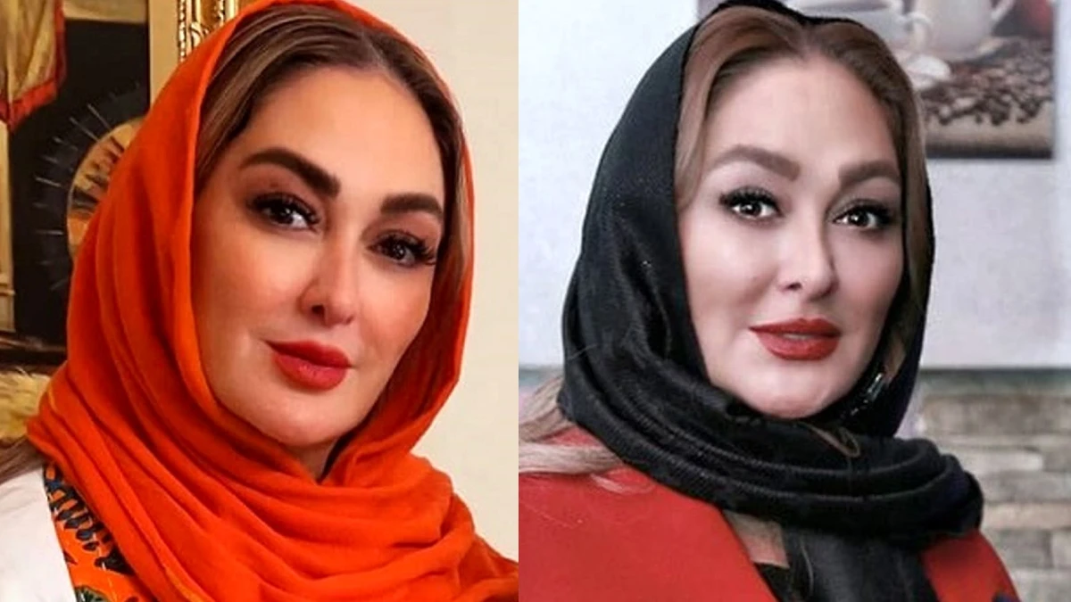چهره الهام حمیدی قبل از عمل