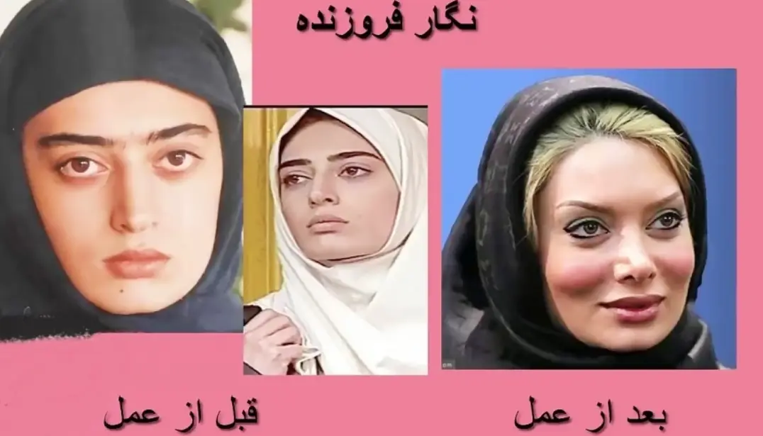خبر روز | عکس های شوکه کننده نگار فروزنده بعد از عمل های زیبایی 4 نگارفروزنده5